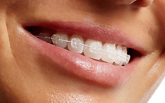 diafani siderakia nikos spyropoulos orthodontikos