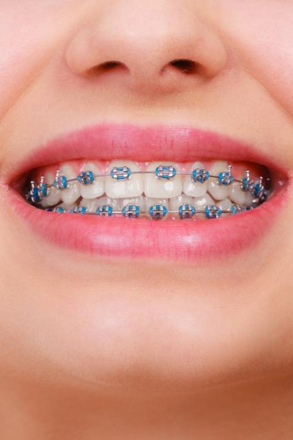 nikos spyropoulos orthodontikos mple siderakia