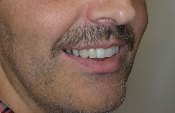 aorati orthodontiki enilikon xamogelo nikos spyropoulos orthodontikos