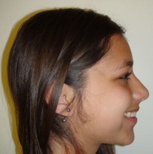 facelift peristatiko nikos spyropoulos orthodontikos