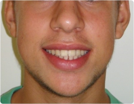 glossika siderakia apotelesmata xamogelo nikos spyropoulos orthodontikos