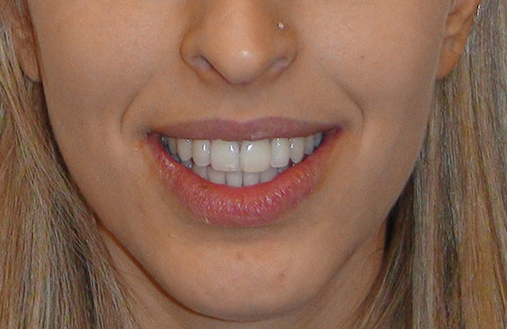 orthodontiko peristatiko enilikes apotelesmata nikos spyropoulos orthodontikos