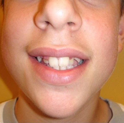 orthodontikos gia paidia nikos spyropoulos orthodontikos